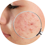 Acne Care